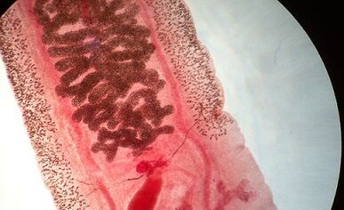 Anquilostomosia gizakiengan